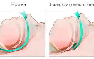 Остановка дыхания во сне?