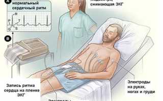 Что такое электрокардиограмма сердца
