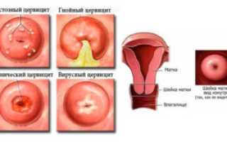 Что такое цервицит, чем опасна хроническая форма, его симптомы, причины и лечение