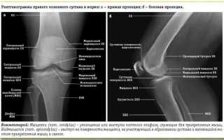 Что такое супрапателлярный бурсит коленного сустава и как его лечить