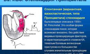 Что такое вазоспастическая стенокардия (стенокардия принцметала)