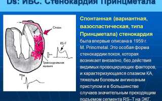 Что такое вазоспастическая стенокардия (стенокардия принцметала)