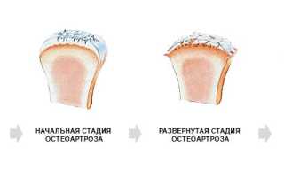 Артродез лучезапястного сустава, симптомы и лечение артроза