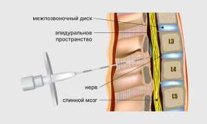 Эпидуральная анестезия при родах
