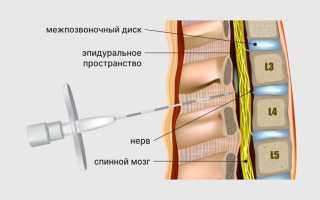 Эпидуральная анестезия при родах