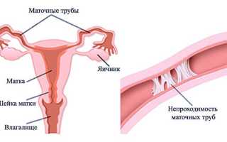 Бесплодие Трубное