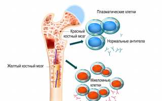 Что такое Миелома