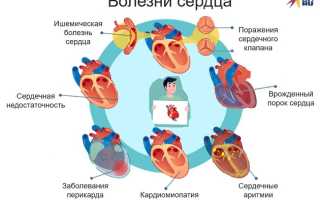 Что входит в понятие «лечение болезней сердца»