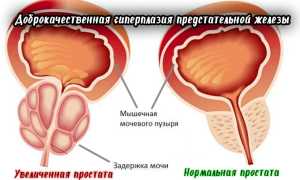 Аденома простаты у мужчин — симптомы и терапия заболевания