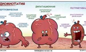Классификация типов кардиомиопатии, причины появления
