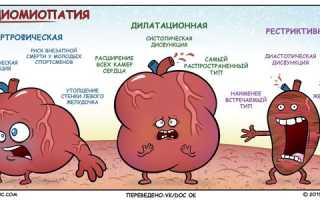 Классификация типов кардиомиопатии, причины появления