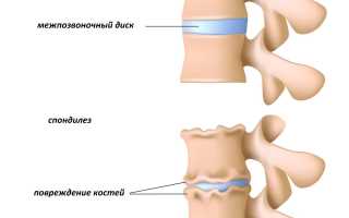 Что это такое – спондилез грудного отдела позвоночника