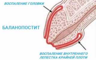 Что такое баланопостит у мужчин и детей, его виды, причины, симптомы и диагностика