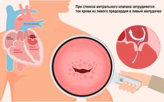 Лечение стеноза митрального клапана – операция по замене митрального клапана