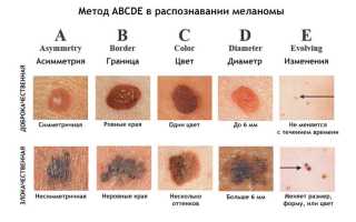 Что такое Меланома