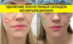 Как убрать носогубные складки