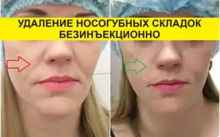 Как убрать носогубные складки