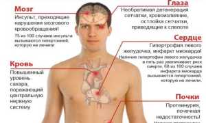 Типичные признаки артериальной гипертонии