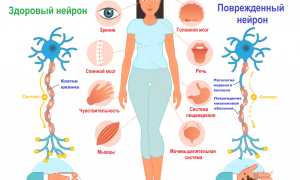Что такое Рассеянный склероз