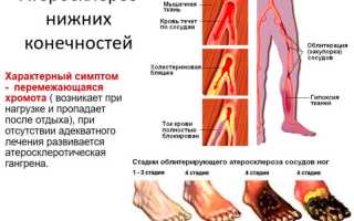 Признаки и лечение облитерирующего атеросклероза нижних конечностей