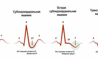 Особенности трансмурального инфаркта миокарда