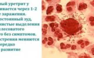 Трихомонадный уретрит: что это такое, симптомы, диагностика, лечение, профилактика