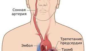 Чем опасно трепетание предсердий
