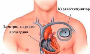 Что такое кардиостимулятор и для чего его вживляют