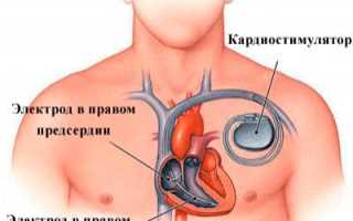 Что такое кардиостимулятор и для чего его вживляют