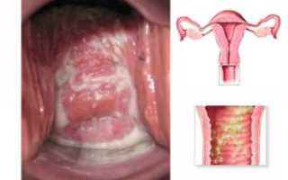 Кольпит: что это такое, опасность, виды, причины, симптомы, диагностика, лечение