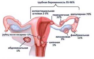 Может ли быть внематочная беременность при ЭКО?