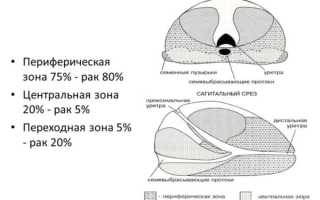 Гормонотерапия при раке простаты