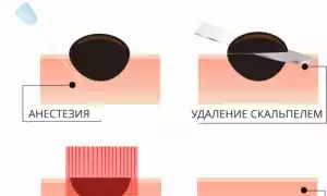 Как лучше удалить родинку?