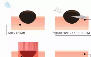 Как лучше удалить родинку?