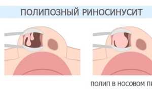 Полипозный риносинусит