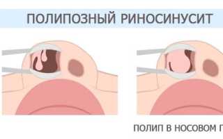 Полипозный риносинусит