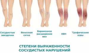 Варикоз — аномалии периферических вен
