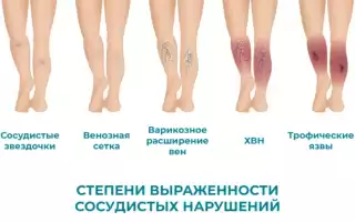 Варикоз — аномалии периферических вен