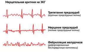 Лечение аритмии сердца различными методами