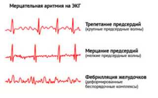 Лечение аритмии сердца различными методами