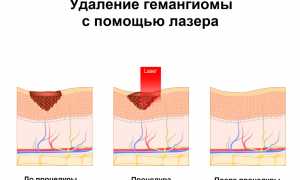 Как проявляется гемангиома у взрослых, причины развития