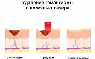 Как проявляется гемангиома у взрослых, причины развития