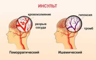 Инсульт: причины и виды