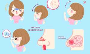 Как избавиться от частых носовых кровотечений?