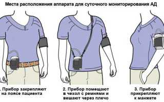 СМАД суточный мониторинг давления показания, как проводят, результаты