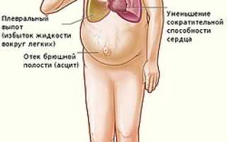 Почему при болезнях сердца развивается асцит