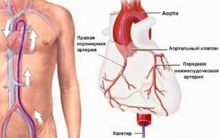 Как и для чего проводят катетеризацию сердца