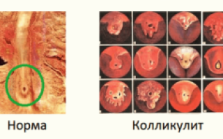 Причины, симптомы и современные методы лечения колликулита у мужчин