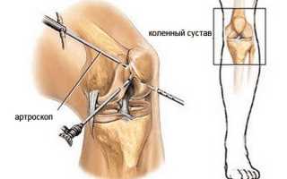 Болезнь Бейкера или киста коленного сустава – что это такое