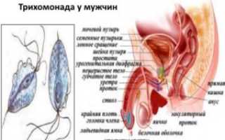 Хронический трихомониаз: этапы развития болезни, опасность, симптомы, лечение, профилактика